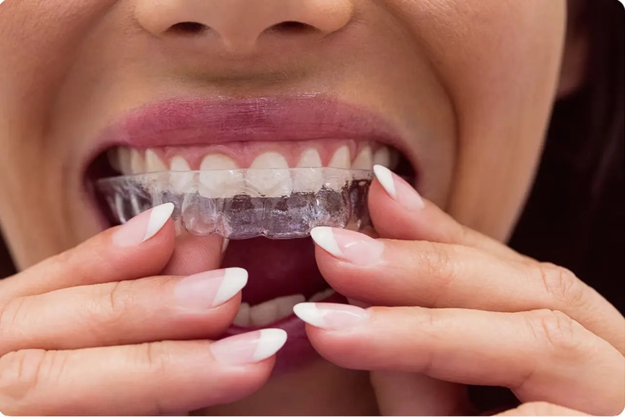 Palatal expansion appliance for adults Adult placing a clear palatal expansion oral appliance, a non-surgical treatment to widen the upper jaw