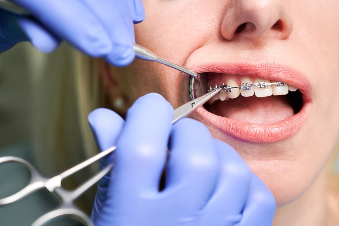 Planning airway-focused orthodontic treatment in Orlando Close-up of orthodontic brackets being adjusted on a patient's upper teeth