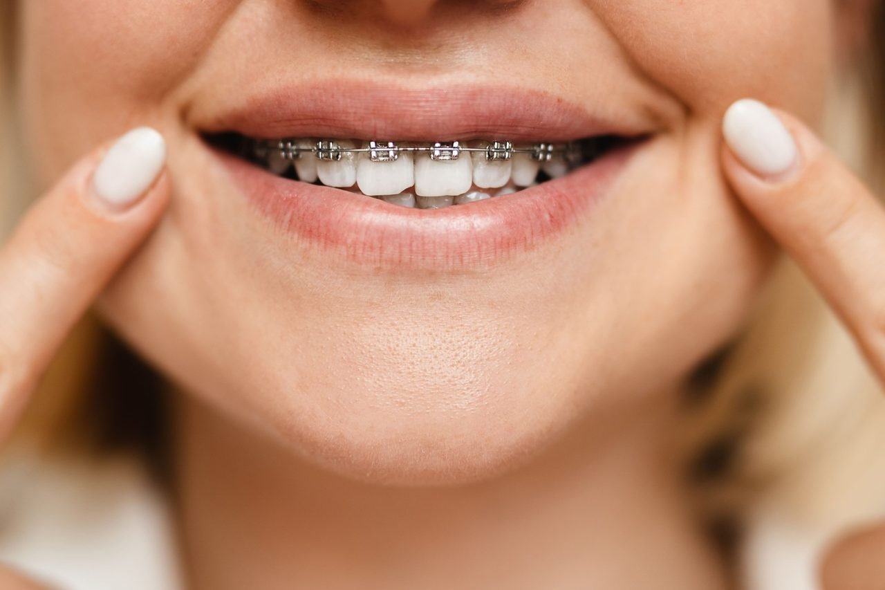 Close-up of a smiling patient with metal braces pointing to her cheeks